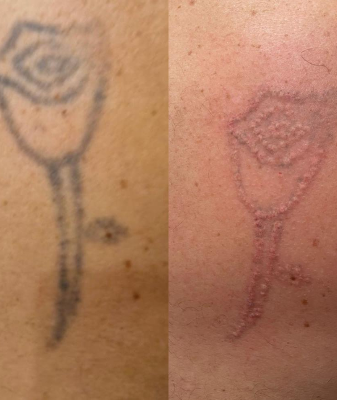 Remoção de Tatuagem — Antes e Depois