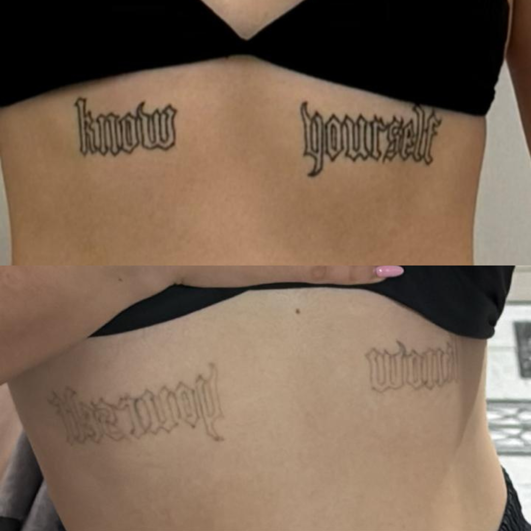 Remoção de Tatuagem — Antes e Depois